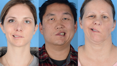 ما حقيقة إصابة 4 أشخاص بالشلل بسبب لقاح فيروس كورونا؟